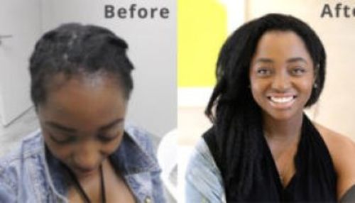 Customer photo review of (30% off )(BUNDLE PACK) REGROWTH -SHAMPOO & CONDITIONER & 1oz EXTRA STRENGTH HAIR SERUM