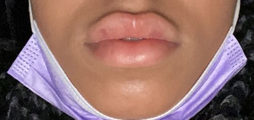 Customer photo review of LipFix: Filler