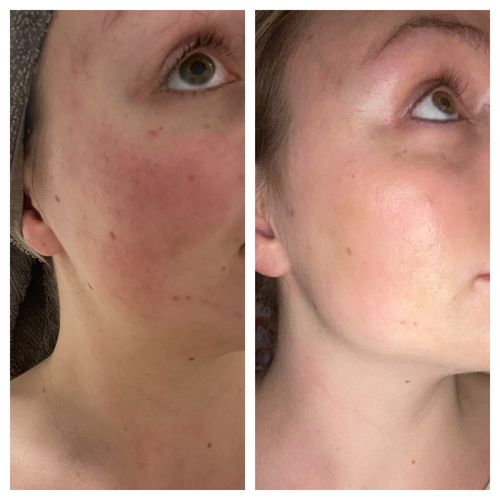 Customer photo review of Rosalique 3 in 1 Anti-Redness Miracle Formula SPF50