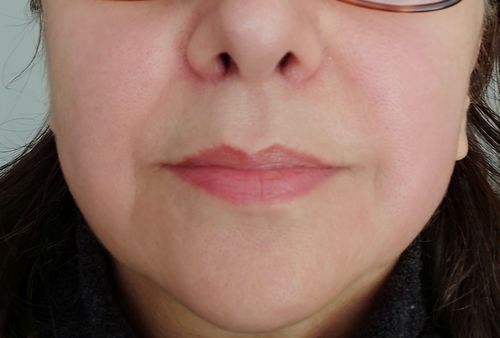 Customer photo review of TriPollar STOP Vx