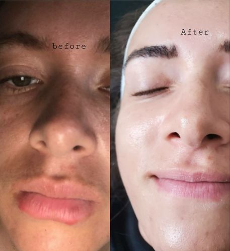 Customer photo review of MesoBright Serum