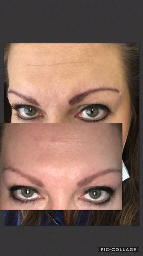 Customer photo review of MesoFirm Serum
