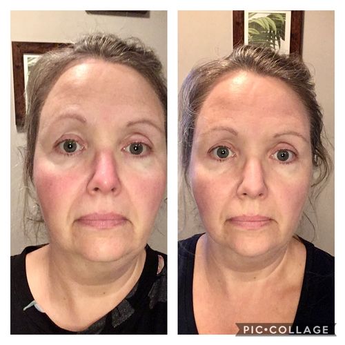 Customer photo review of Rosalique 3 in 1 Anti-Redness Miracle Formula SPF50