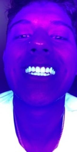 Customer photo review of Teeth Whitening Kit