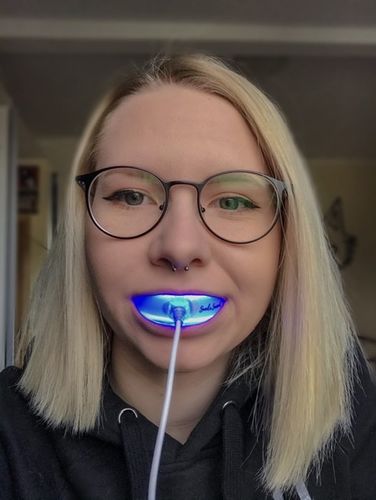 Customer photo review of PAP+ LED Teeth Whitening Kit
