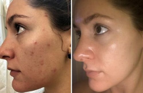 Customer photo review of Dermalights™ - Masque de Photothérapie à LED Professionel