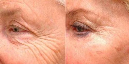 Customer photo review of Dermalights™ - Masque de Photothérapie à LED Professionel