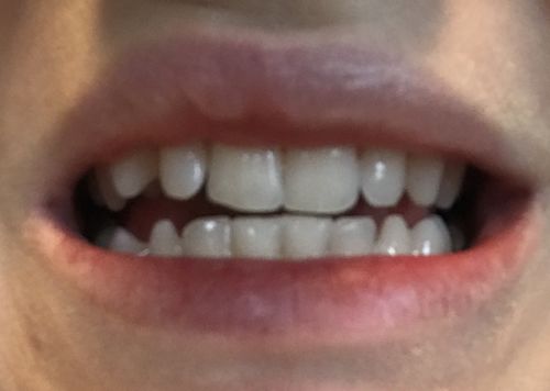 Customer photo review of SmileSecret Phonebleaching®