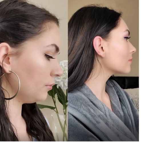 Customer photo review of DermaV™  |  Masque amincissant pour ovale du visage