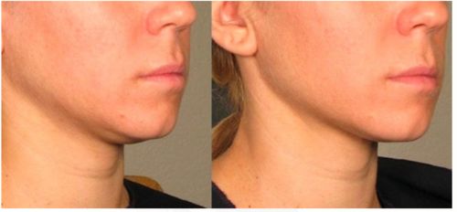 Customer photo review of DermaV™  |  Masque amincissant pour ovale du visage