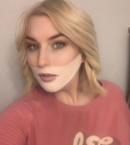 Customer photo review of DermaV™  |  Masque amincissant pour ovale du visage