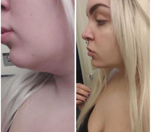 Customer photo review of DermaV™  |  Masque amincissant pour ovale du visage