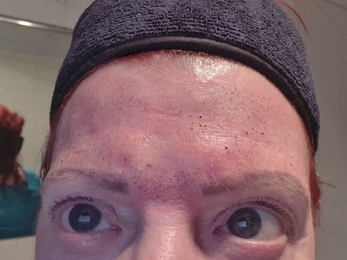 Customer photo review of Advanced Fibroblast Mini Course- Stretch Marks