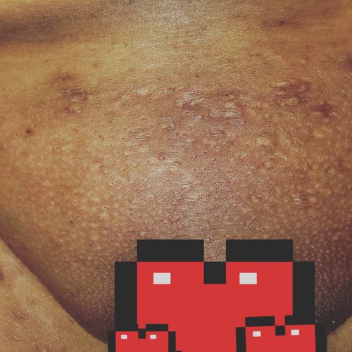 Customer photo review of Pro Series Hair Removal Wax