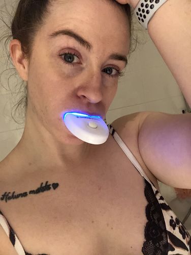 Customer photo review of Teeth Whitening Kit