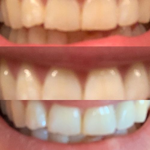 Customer photo review of PAP+ LED Teeth Whitening Kit