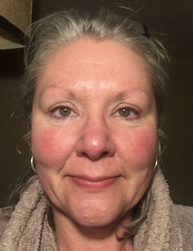 Customer photo review of Rosalique 3 in 1 Anti-Redness Miracle Formula SPF50