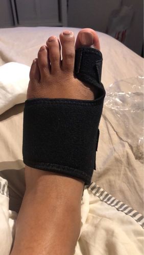 Customer photo review of BYE BYE Bunion! Orthopedic Bunion Corrector (Pair)