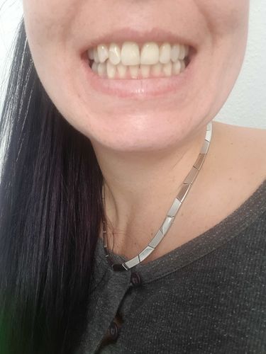 Customer photo review of SmileSecret Phonebleaching®