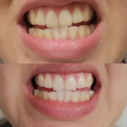 Customer photo review of SmileSecret Phonebleaching®