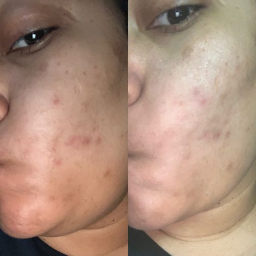 Customer photo review of SkinCare Bundle