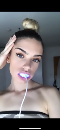 Customer photo review of PAP+ LED Teeth Whitening Kit