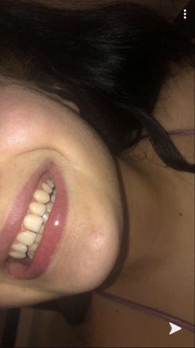 Customer photo review of Teeth Whitening Kit