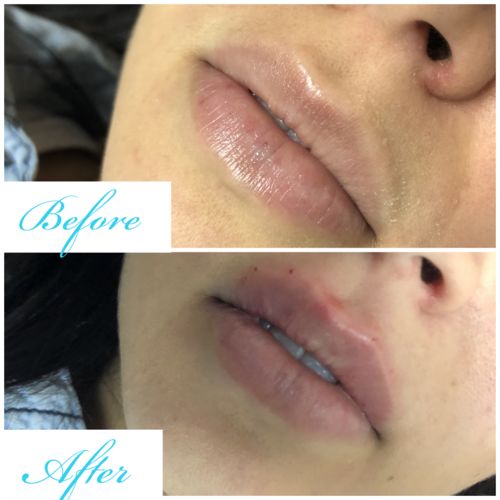 Customer photo review of ScalpaJECT Hyaluronic Acid Gel