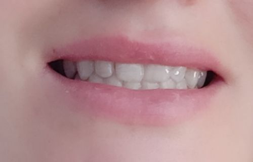 Customer photo review of LIP BOOSTING SYSTEM