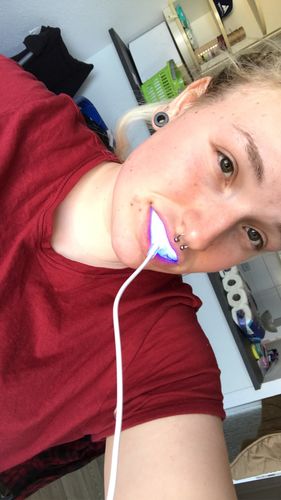 Customer photo review of SmileSecret Phonebleaching®