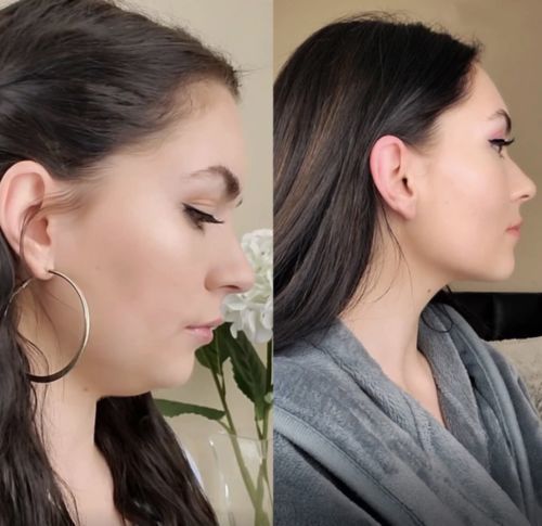 Customer photo review of DermaV™  |  Masque amincissant pour ovale du visage