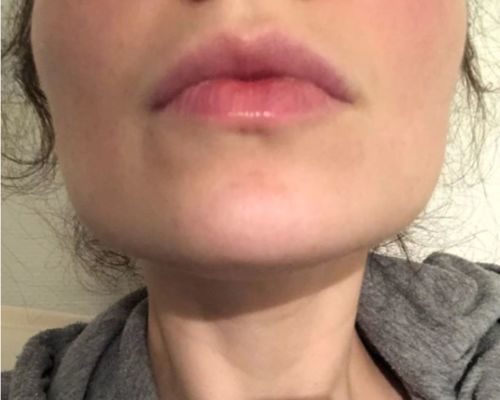 Customer photo review of DermaV™  |  Masque amincissant pour ovale du visage