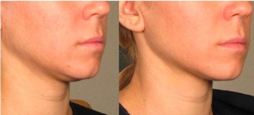 Customer photo review of DermaV™  |  Masque amincissant pour ovale du visage