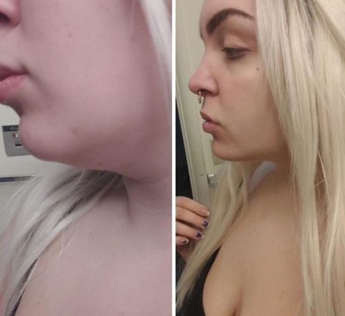 Customer photo review of Masque amincissant DermaV™