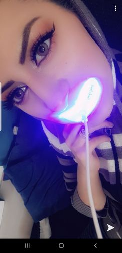 Customer photo review of PAP+ LED Teeth Whitening Kit