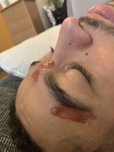 Customer photo review of KIT ÉPILATION 4X CIRES (+1 SPATULE GRATUITE)