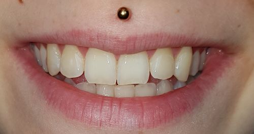 Customer photo review of SmileSecret Phonebleaching®