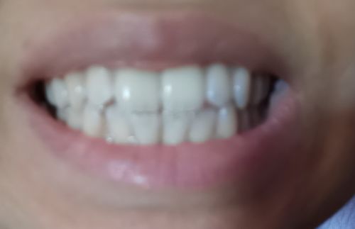 Customer photo review of PAP+ LED Teeth Whitening Kit
