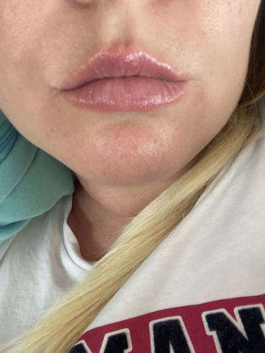 Customer photo review of LIP BOOSTING SYSTEM