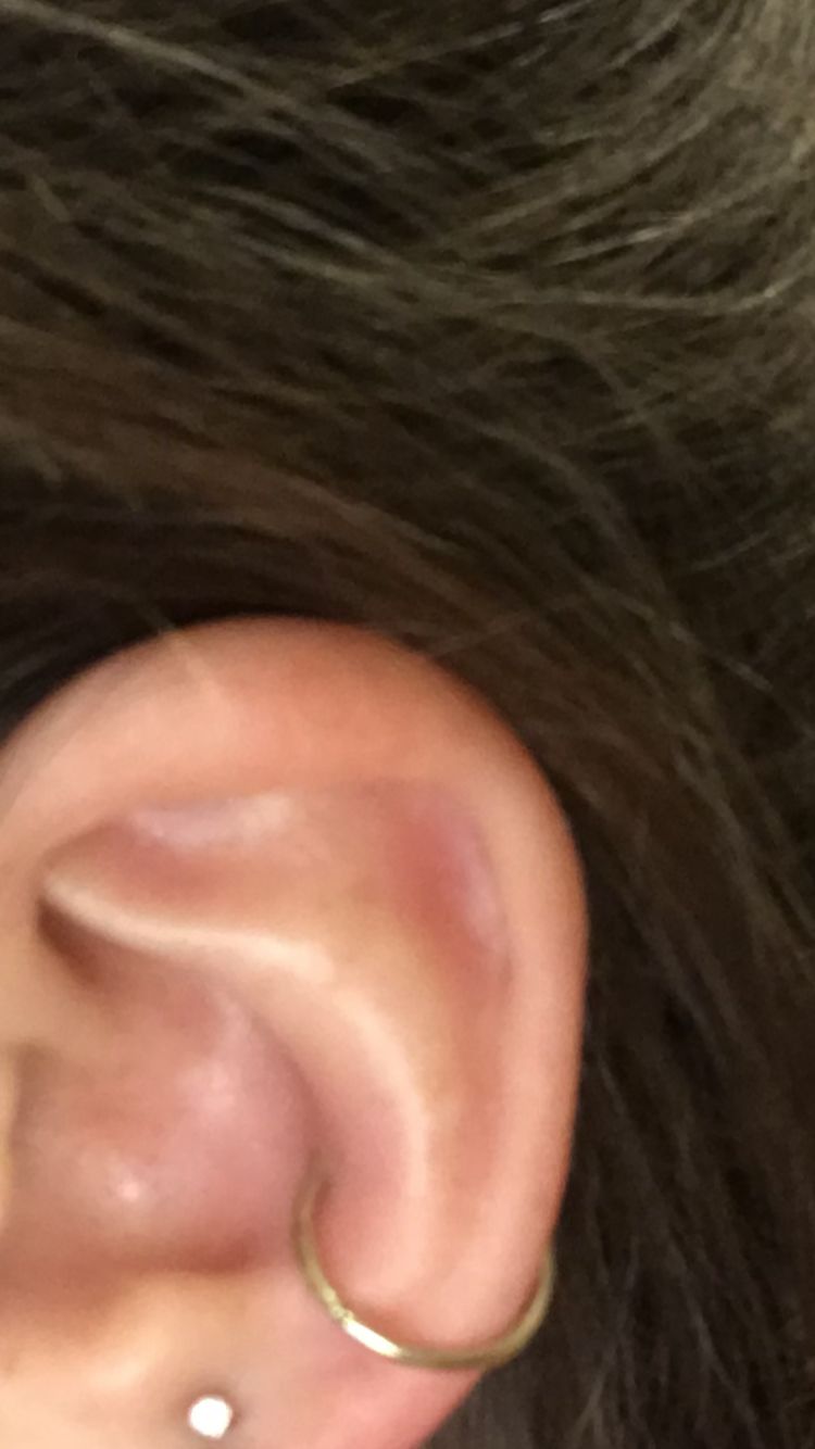 Customer photo review of NeilMed Sterile Saline Piercing Aftercare