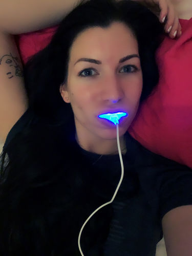 Customer photo review of PAP+ LED Teeth Whitening Kit