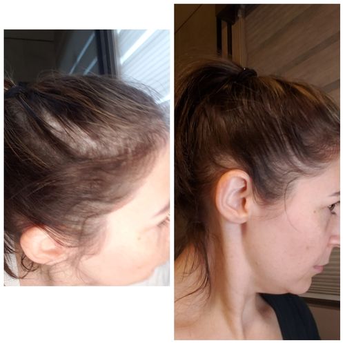 Customer photo review of NutraM Topical Melatonin Hair Growth Serum for Thinning Hair - Clinically Researched - 2oz  15.00% Off Auto renew