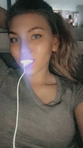 Customer photo review of PAP+ LED Teeth Whitening Kit
