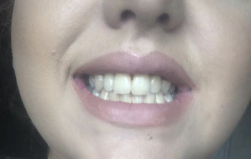 Customer photo review of Teeth Whitening Kit