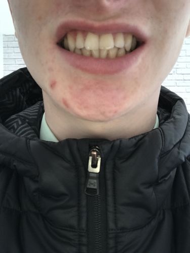 Customer photo review of White Edition – Tooth Polish