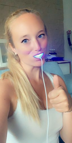 Customer photo review of PAP+ LED Teeth Whitening Kit
