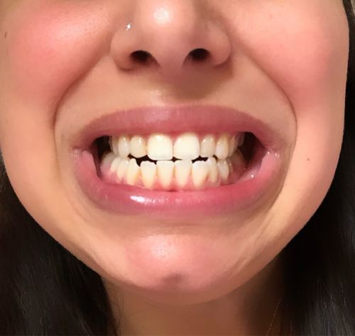 Customer photo review of PAP+ LED Teeth Whitening Kit