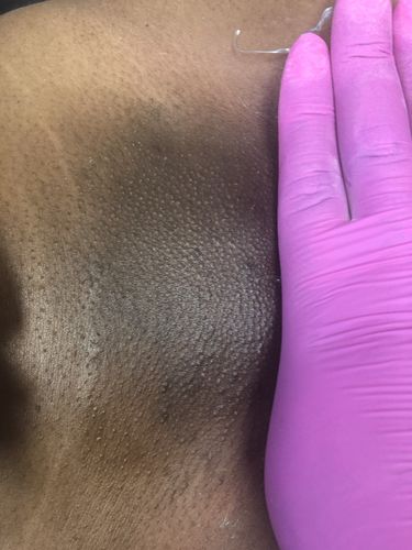 Customer photo review of Glitter Bombs | Glitter Wax For Hair Removal