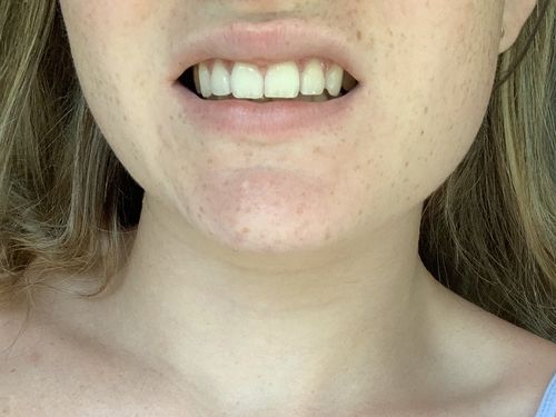 Customer photo review of Teeth Whitening Kit