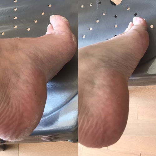 Customer photo review of LOVASKIN INSTANT FOOT PEEL Essential Kit - Great value, 25 uses in one bottle